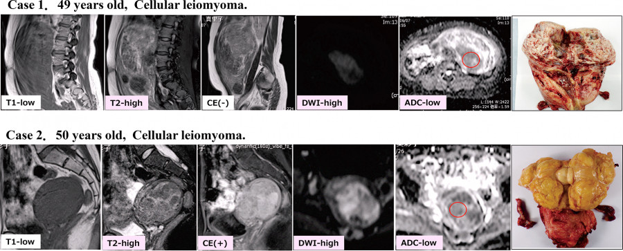 Images of MRI scans and pathological specimens related to two cases of cellular leiomyoma in patients aged 49 and 50.