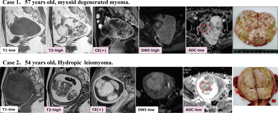 Medical imaging comparison of two cases: myxoid degenerated myoma and hydropic leiomyoma, with MRI scans and pathology images.