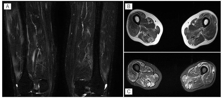 MRI images showing bilateral muscle inflammation in the lower thighs, with high signals on STIR and T1-weighted sequences.