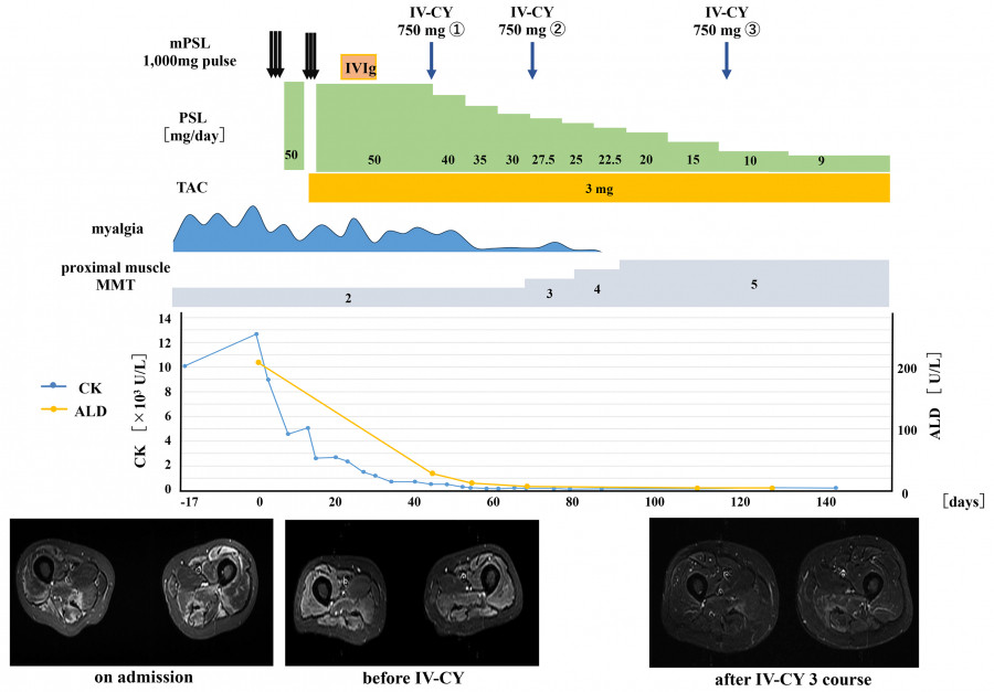 Clinical timeline and MRI images showing treatment progress of a 51-year-old male with anti-SRP antibody-positive myositis.