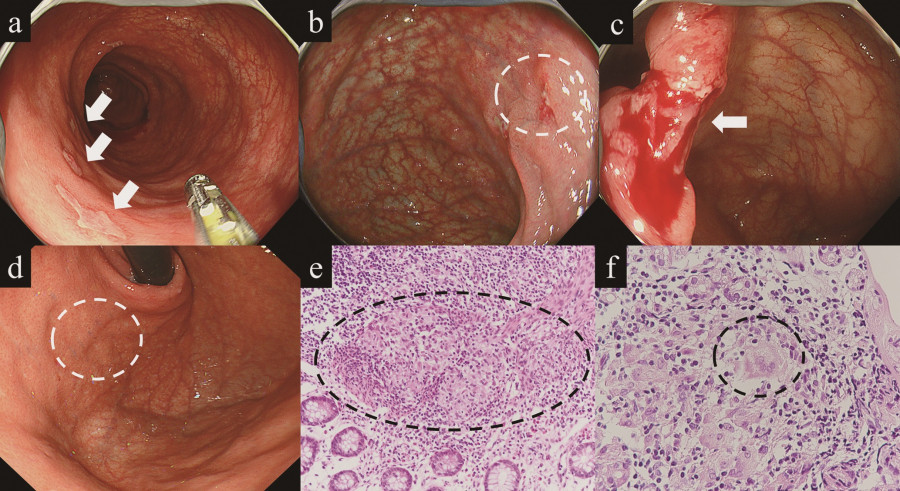 Endoscopic images showing various stages of gastrointestinal examination, highlighting abnormalities and tissue samples.