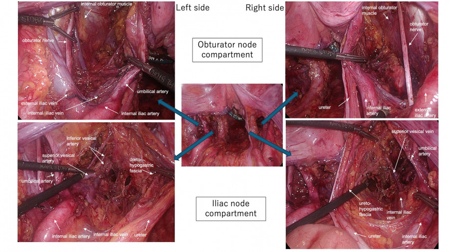 Surgical images showing the left and right sides of the obturator and iliac node compartments, with labeled anatomical structures.