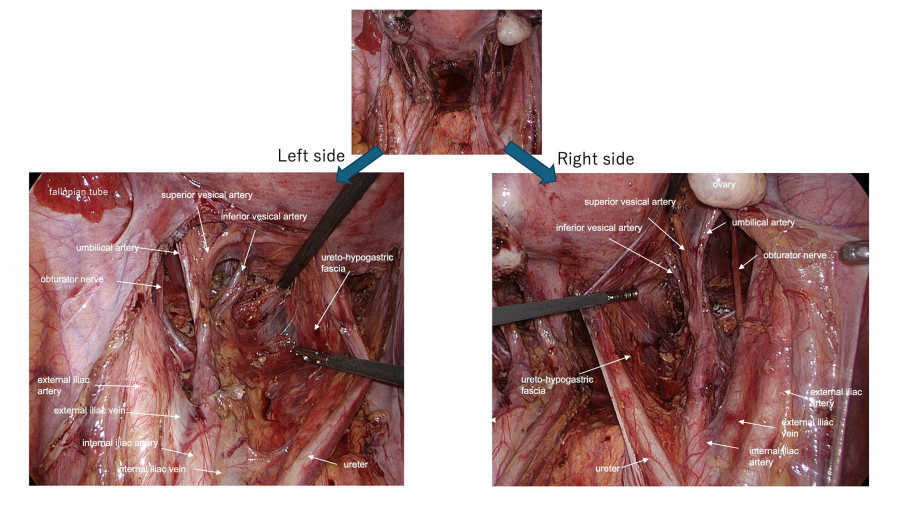 Surgical view of the left and right sides of the neck, highlighting major arteries and anatomical structures.