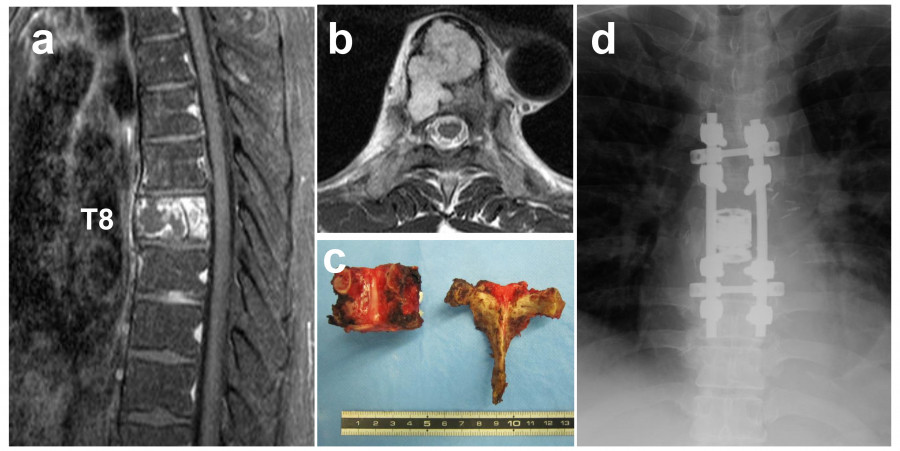 MRI images showing spinal structures, including vertebrae and surgical hardware.