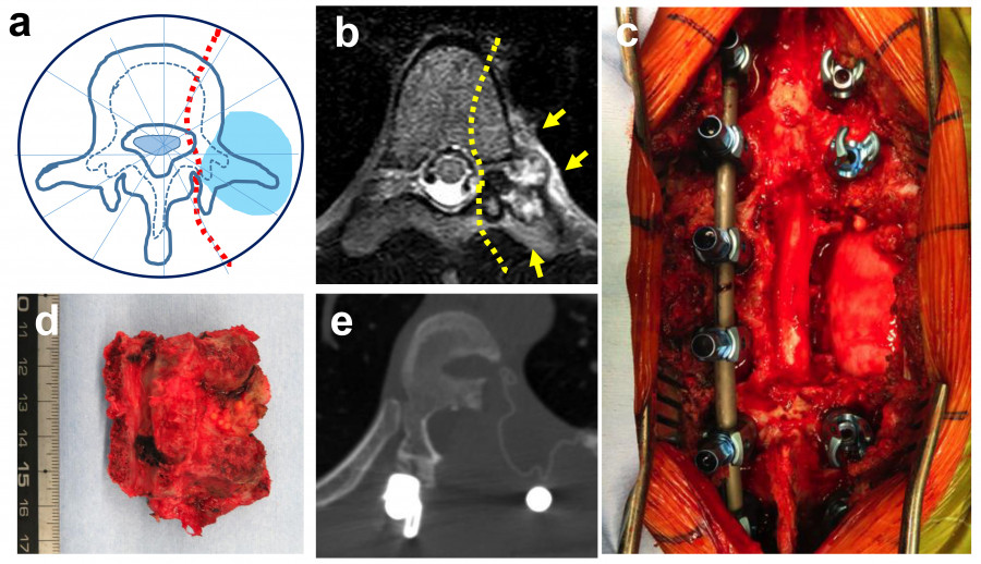 Illustration of anatomical structures related to the spine, including MRI images and surgical views.