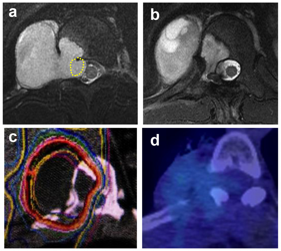 MRI images showing different views of the heart, highlighting anatomical structures and potential abnormalities.