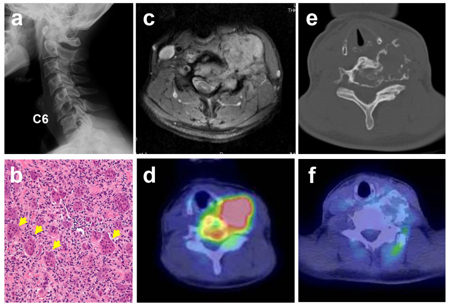 ALT: Medical imaging series showing cervical spine X-ray, MRI, and CT scans for diagnostic evaluation.