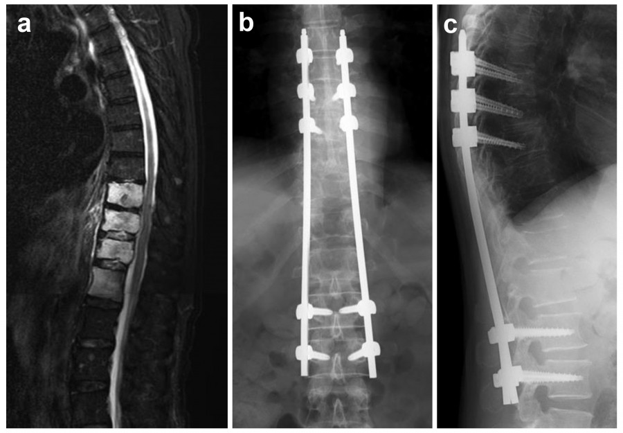 MRI and X-ray images showing spinal structures and surgical hardware for medical analysis.