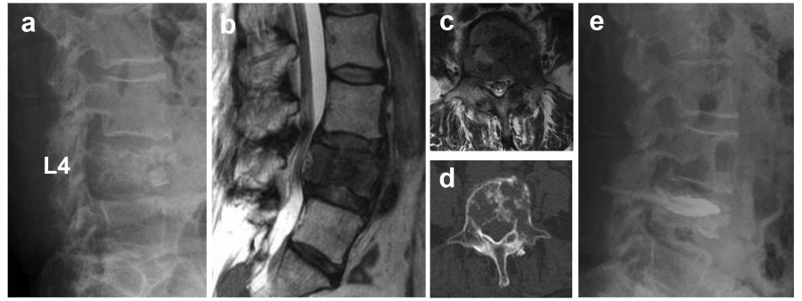 MRI images of the lumbar spine showing various views of the L4 vertebra and surrounding structures.