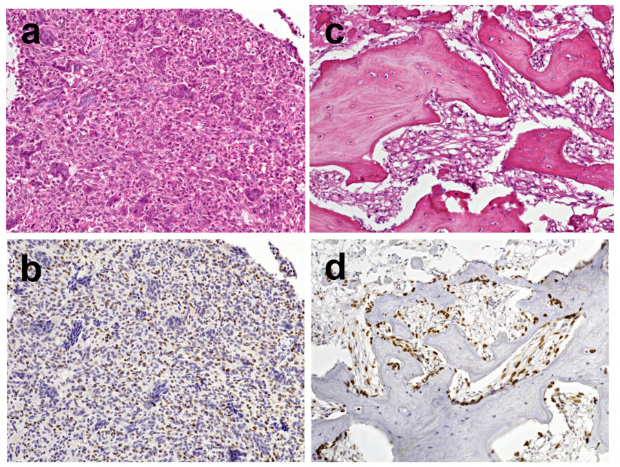 Histological images of giant cell tumor of bone, showing HE staining and immunostaining before and after denosumab treatment.