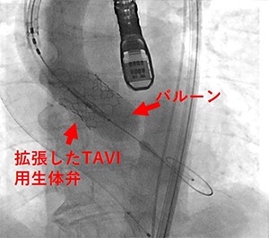 胸部X線画像で、TAVI用生体弁がバルーンで拡張された様子。弁とバルーンが表示されています。