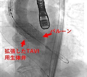 経カテーテル大動脈弁植え込み術（TAVI）